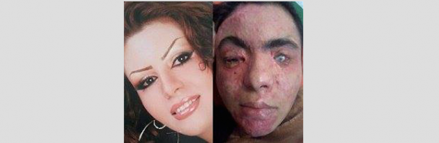 Acid attack victim Hila Jorkesh